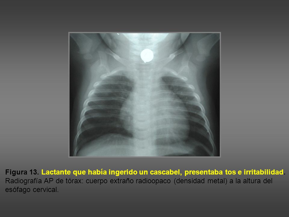 Figura 13. Lactante que había ingerido un cascabel, presentaba tos e irritabilidad.