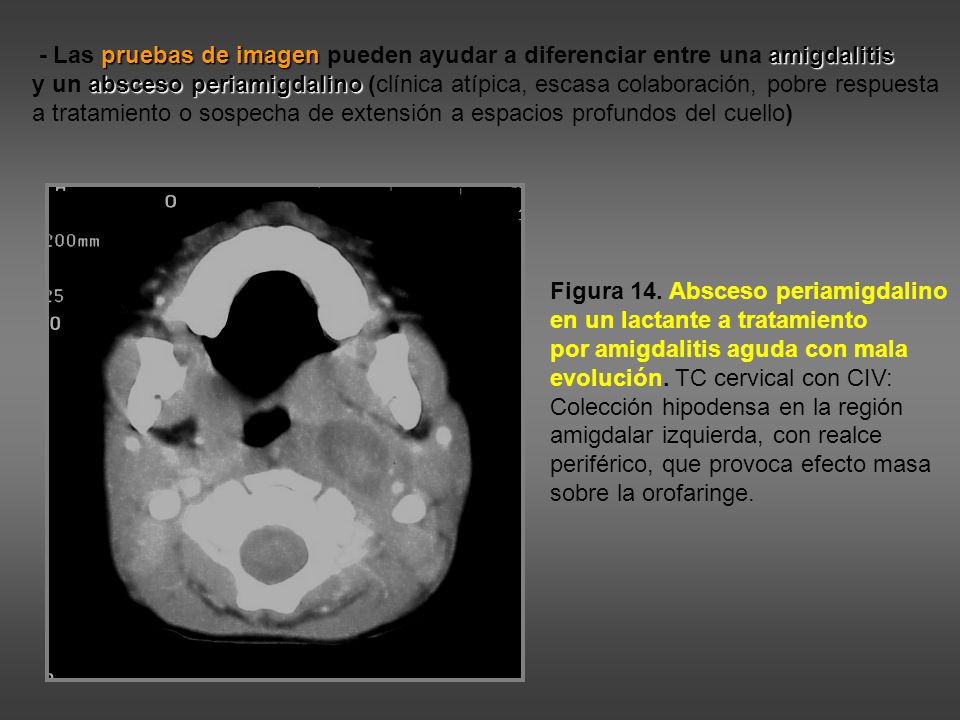 - Las pruebas de imagen pueden ayudar a diferenciar entre una amigdalitis