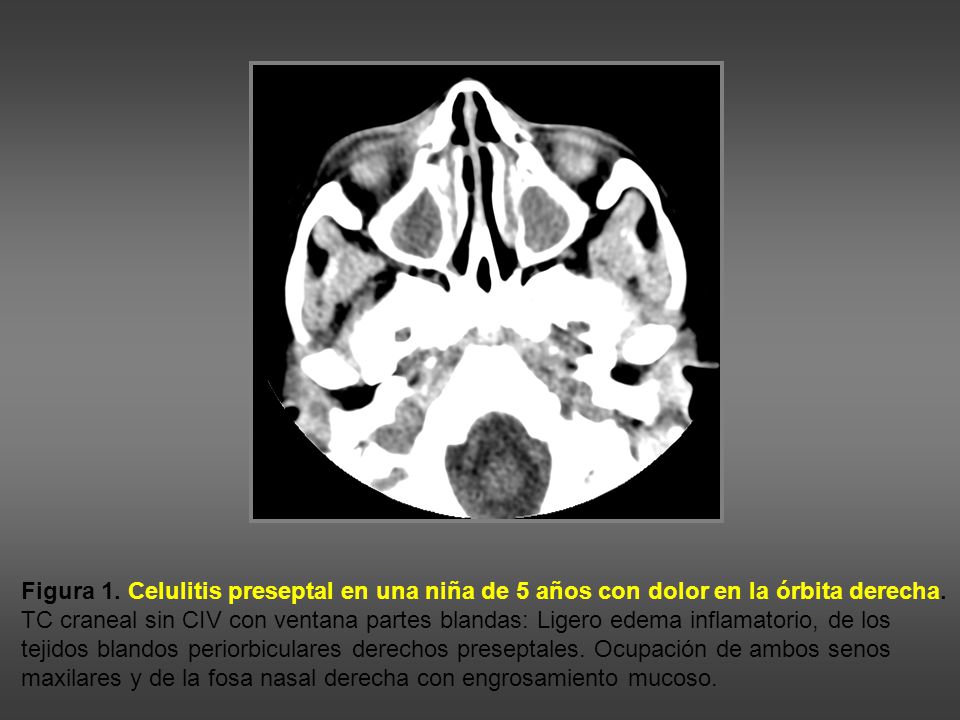 Figura 1. Celulitis preseptal en una niña de 5 años con dolor en la órbita derecha.