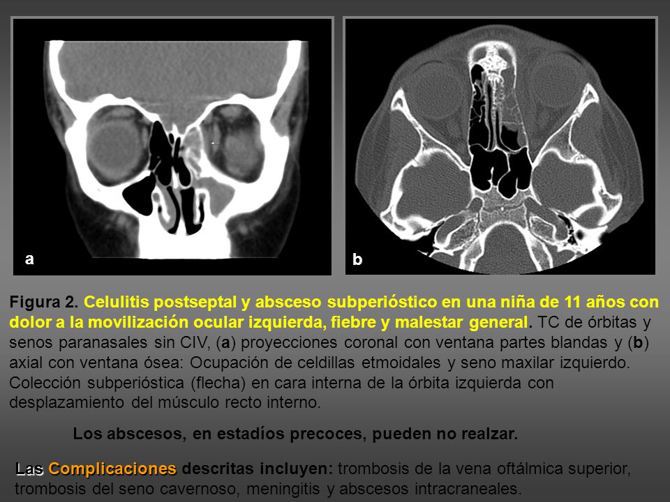 b a. b. Figura 2. Celulitis postseptal y absceso subperióstico en una niña de 11 años con.
