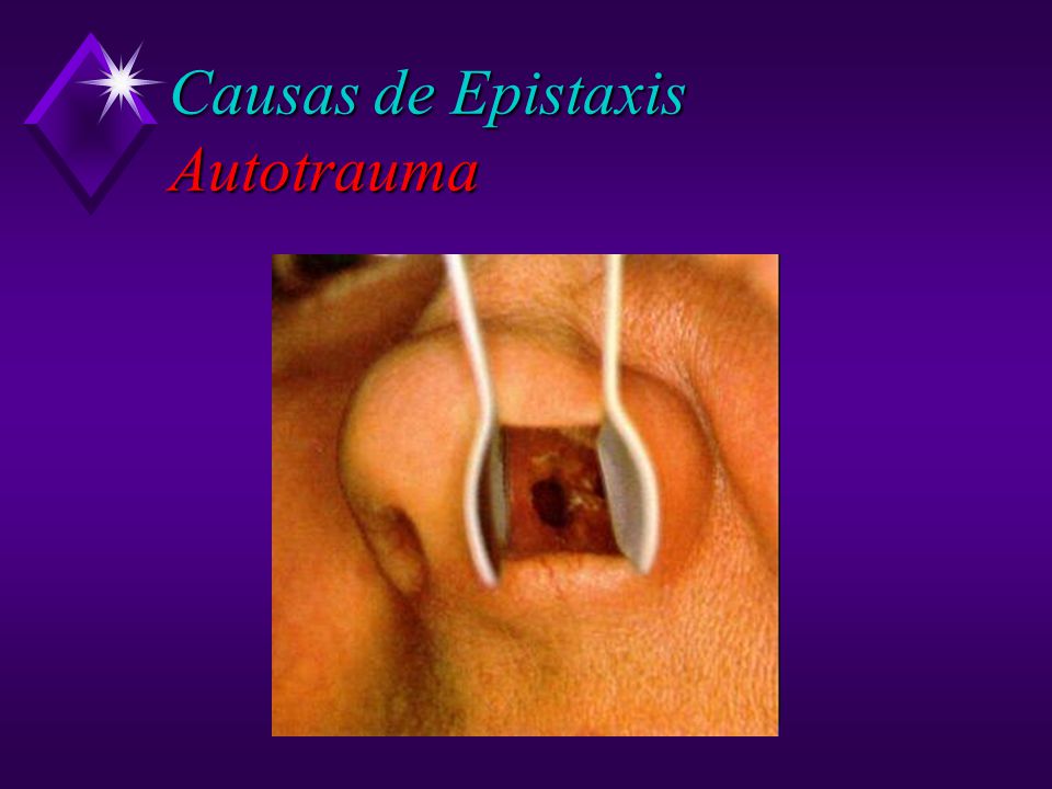 Causas de Epistaxis Autotrauma