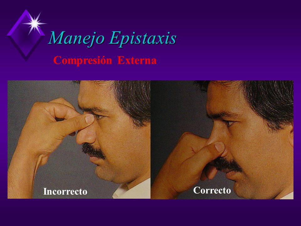 Manejo Epistaxis Compresión Externa Incorrecto Correcto