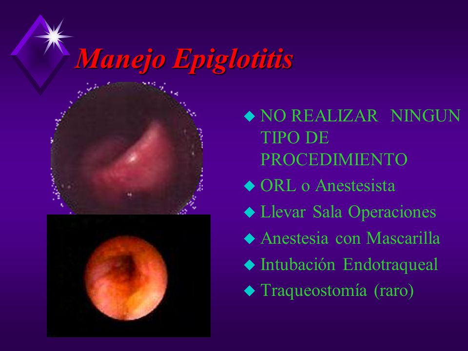 Manejo Epiglotitis NO REALIZAR NINGUN TIPO DE PROCEDIMIENTO