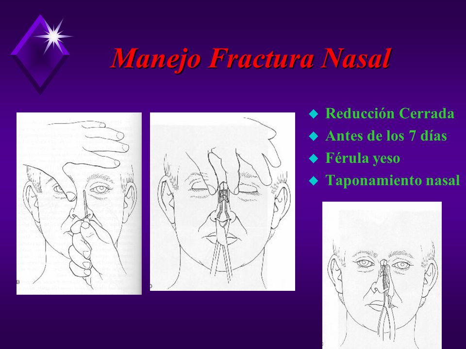 Manejo Fractura Nasal Reducción Cerrada Antes de los 7 días