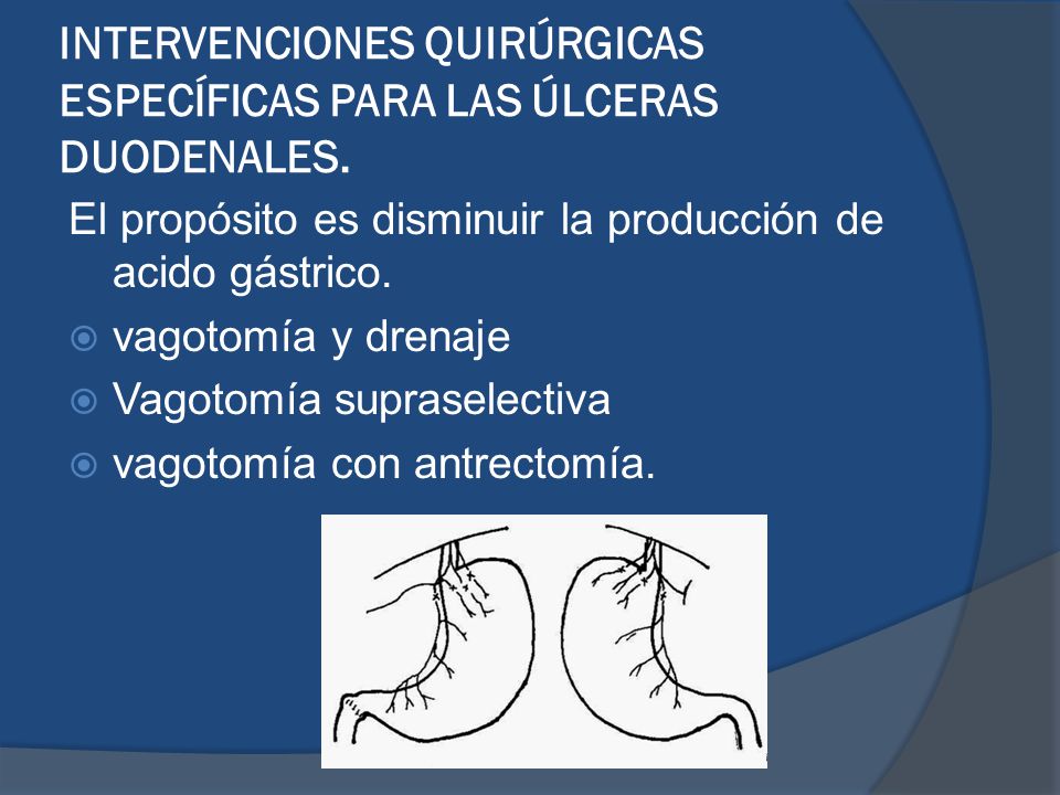 INTERVENCIONES QUIRÚRGICAS ESPECÍFICAS PARA LAS ÚLCERAS DUODENALES.