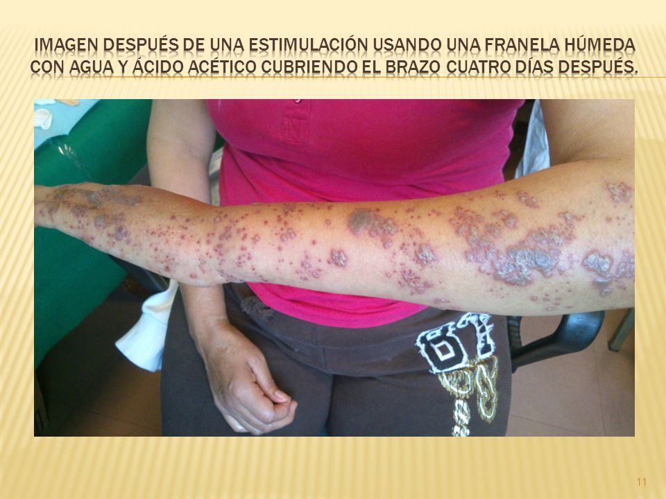 IMAGEN DESPUÉS DE UNA ESTIMULACIÓN USANDO UNA FRANELA HÚMEDA CON AGUA Y ÁCIDO ACÉTICO CUBRIENDO EL BRAZO CUATRO DÍAS DESPUÉS.