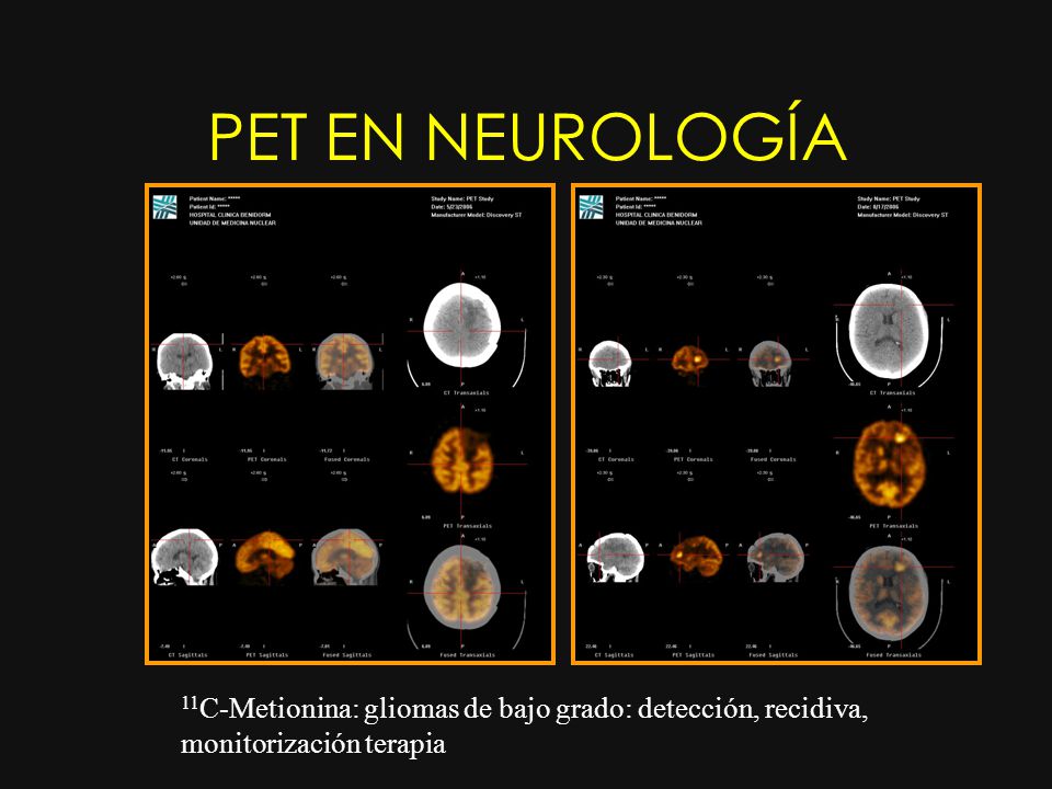 PET EN NEUROLOGÍA 11C-Metionina: gliomas de bajo grado: detección, recidiva, monitorización terapia
