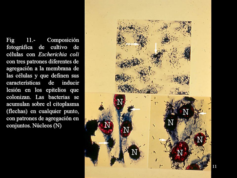 Fig 11.- Composición fotográfica de cultivo de células con Escherichia coli con tres patrones diferentes de agregación a la membrana de las células y que definen sus características de inducir lesión en los epitelios que colonizan.