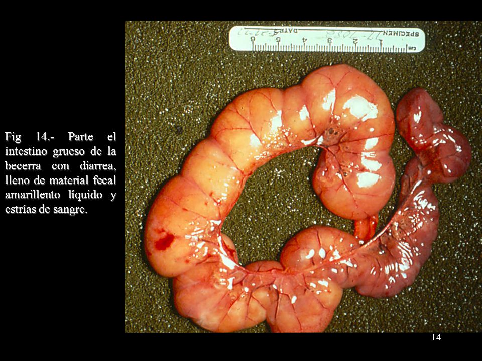 Fig 14.- Parte el intestino grueso de la becerra con diarrea, lleno de material fecal amarillento líquido y estrías de sangre.
