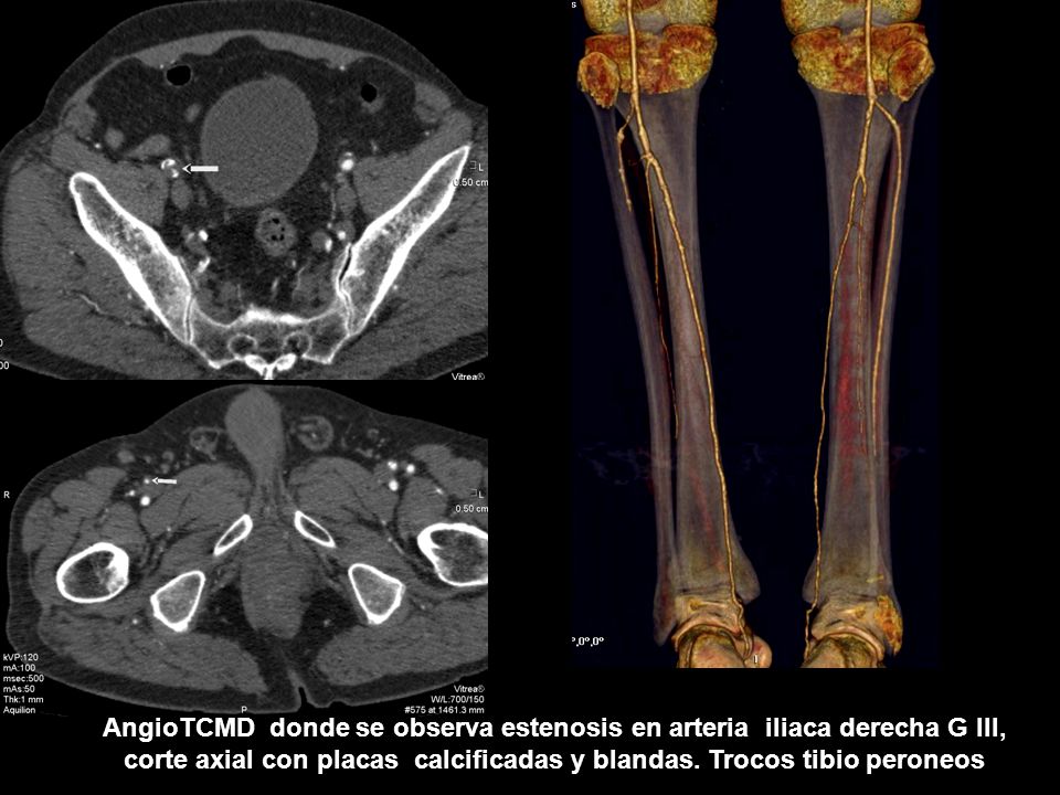 AngioTCMD donde se observa estenosis en arteria iliaca derecha G III, corte axial con placas calcificadas y blandas.