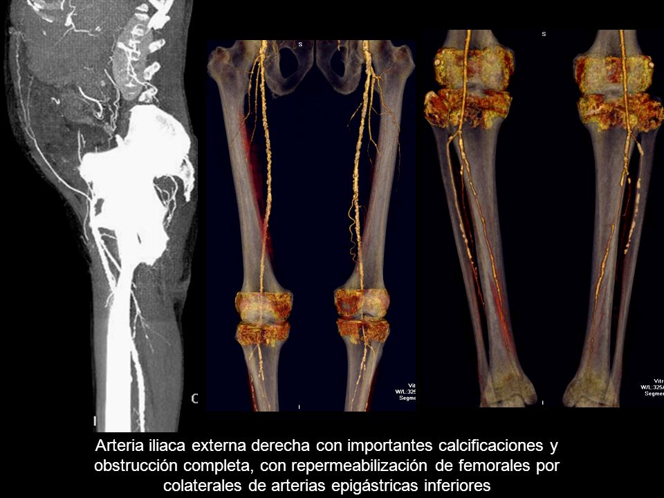 Arteria iliaca externa derecha con importantes calcificaciones y obstrucción completa, con repermeabilización de femorales por colaterales de arterias epigástricas inferiores