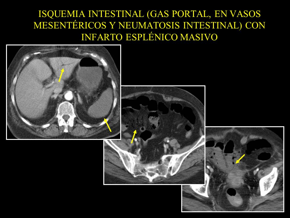 ISQUEMIA INTESTINAL (GAS PORTAL, EN VASOS MESENTÉRICOS Y NEUMATOSIS INTESTINAL) CON INFARTO ESPLÉNICO MASIVO