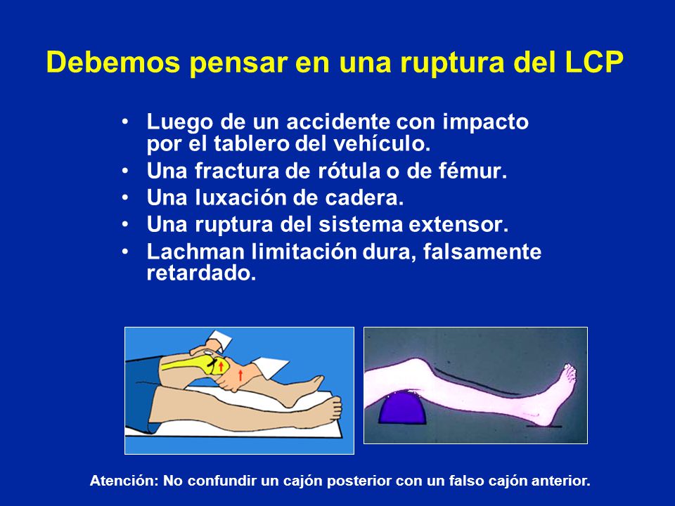Debemos pensar en una ruptura del LCP