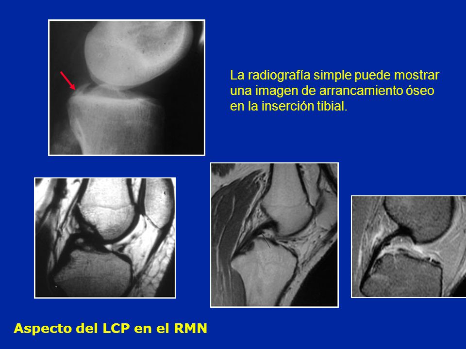 La radiografía simple puede mostrar una imagen de arrancamiento óseo en la inserción tibial.