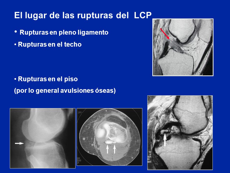 El lugar de las rupturas del LCP Rupturas en pleno ligamento
