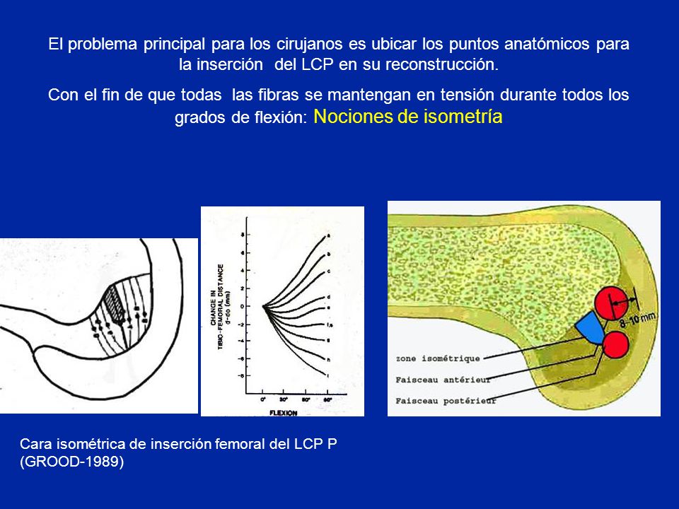 El problema principal para los cirujanos es ubicar los puntos anatómicos para la inserción del LCP en su reconstrucción.