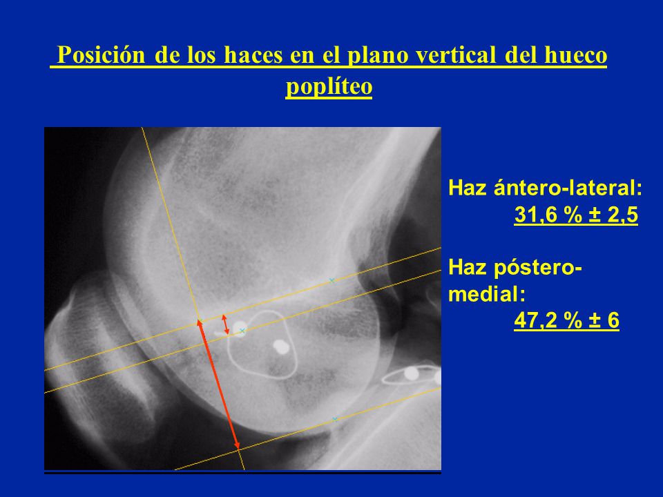 Posición de los haces en el plano vertical del hueco poplíteo