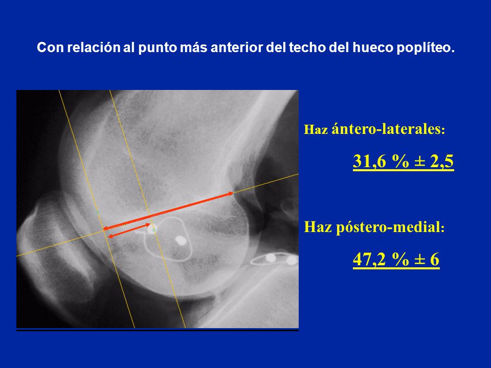 Con relación al punto más anterior del techo del hueco poplíteo.