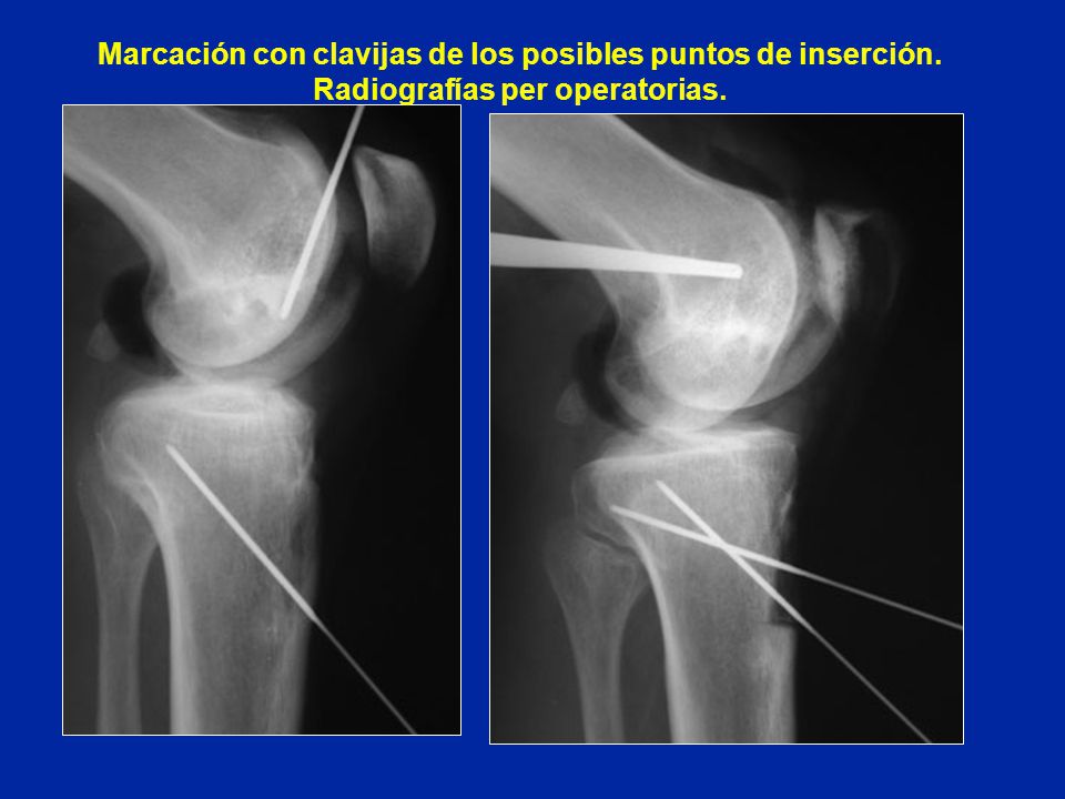 Marcación con clavijas de los posibles puntos de inserción