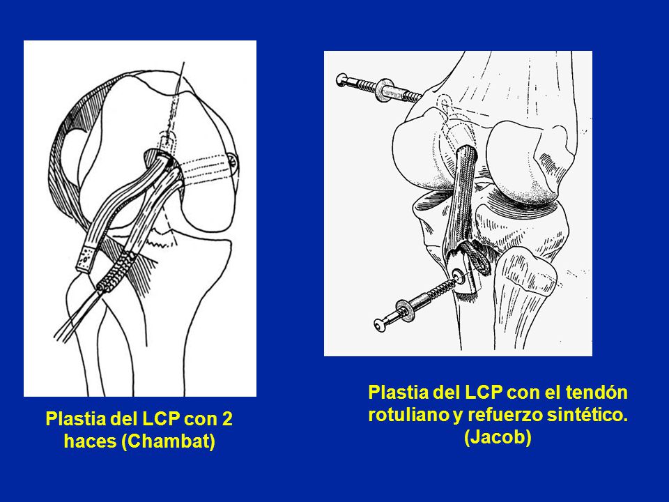 Plastia del LCP con el tendón rotuliano y refuerzo sintético. (Jacob)