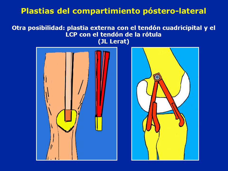 Plastias del compartimiento póstero-lateral Otra posibilidad: plastia externa con el tendón cuadricipital y el LCP con el tendón de la rótula (JL Lerat)