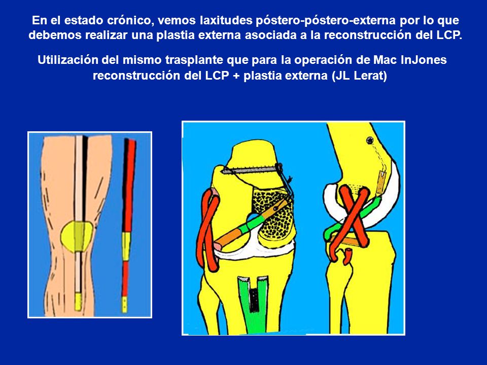 En el estado crónico, vemos laxitudes póstero-póstero-externa por lo que debemos realizar una plastia externa asociada a la reconstrucción del LCP.