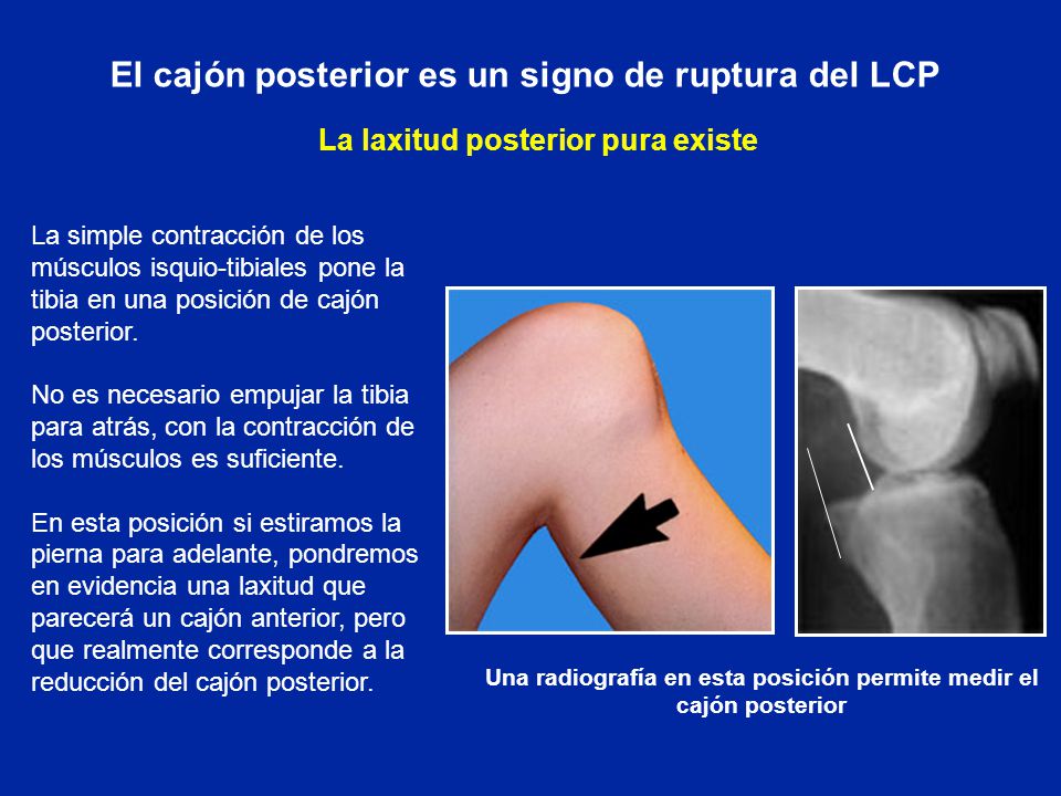 El cajón posterior es un signo de ruptura del LCP