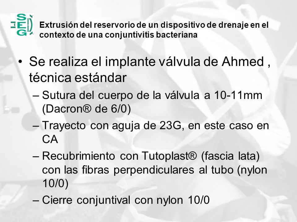 Se realiza el implante válvula de Ahmed , técnica estándar
