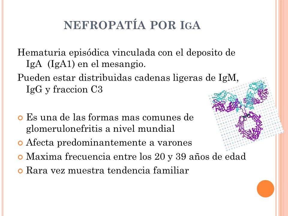 NEFROPATÍA POR IgA Hematuria episódica vinculada con el deposito de IgA (IgA1) en el mesangio.