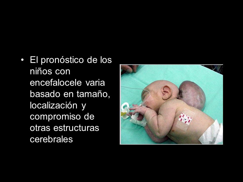 El pronóstico de los niños con encefalocele varia basado en tamaño, localización y compromiso de otras estructuras cerebrales