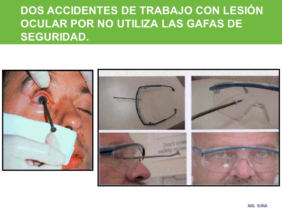 DOS ACCIDENTES DE TRABAJO CON LESIÓN OCULAR POR NO UTILIZA LAS GAFAS DE SEGURIDAD.