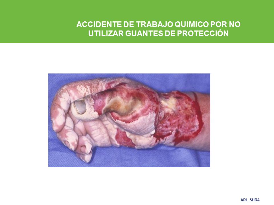 ACCIDENTE DE TRABAJO QUIMICO POR NO UTILIZAR GUANTES DE PROTECCIÓN