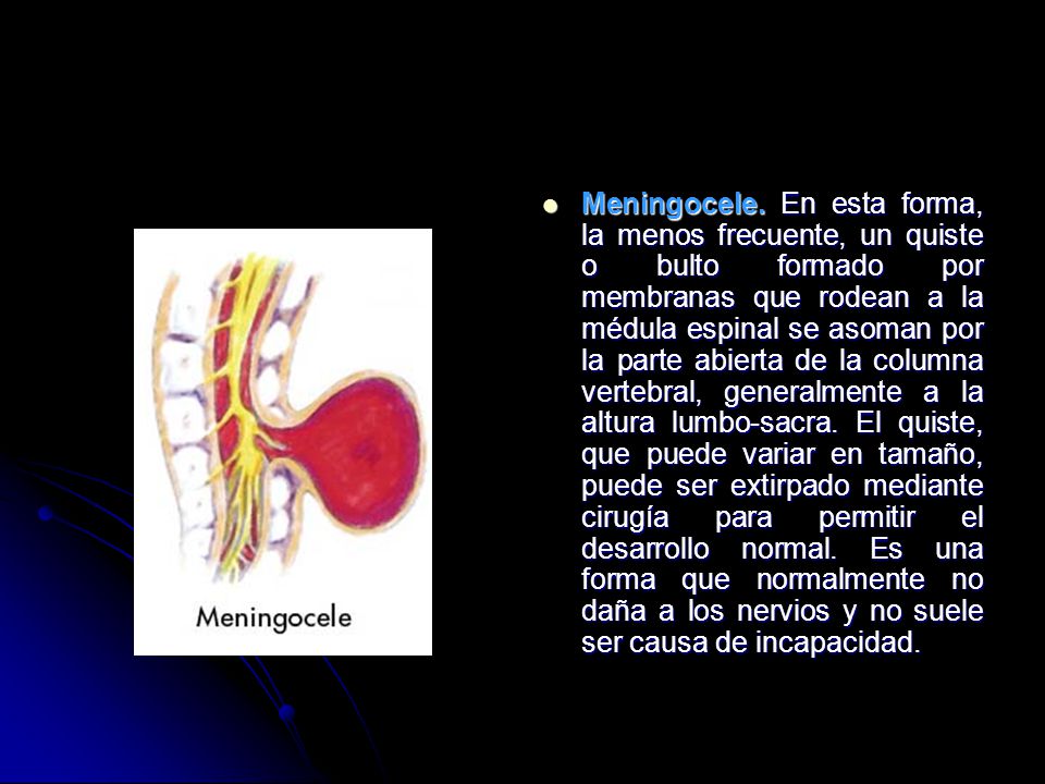 Meningocele.