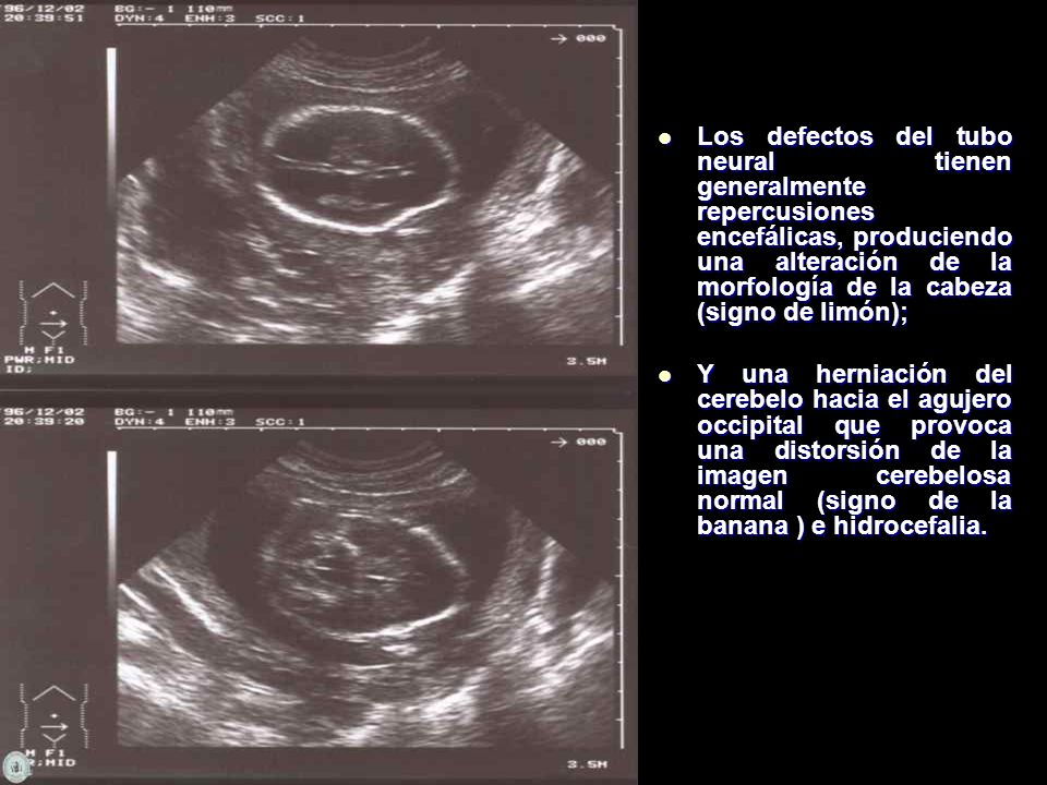 Los defectos del tubo neural tienen generalmente repercusiones encefálicas, produciendo una alteración de la morfología de la cabeza (signo de limón);