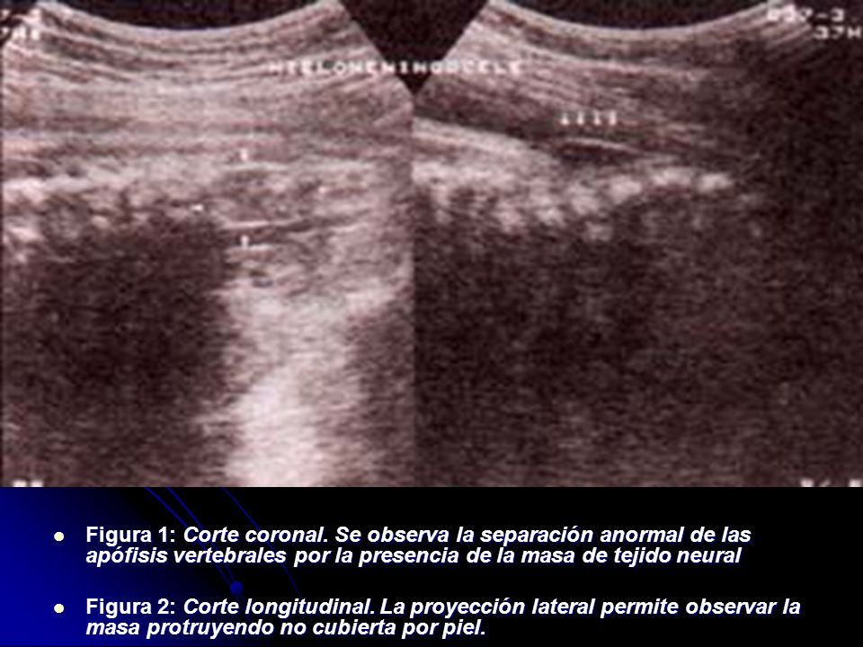 Figura 1: Corte coronal. Se observa la separación anormal de las apófisis vertebrales por la presencia de la masa de tejido neural