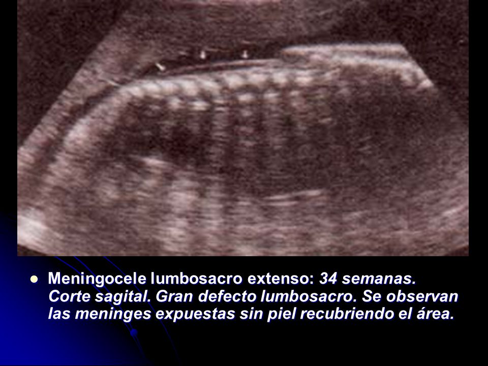 Meningocele lumbosacro extenso: 34 semanas. Corte sagital
