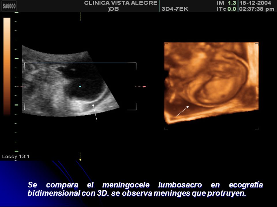 Se compara el meningocele lumbosacro en ecografía bidimensional con 3D
