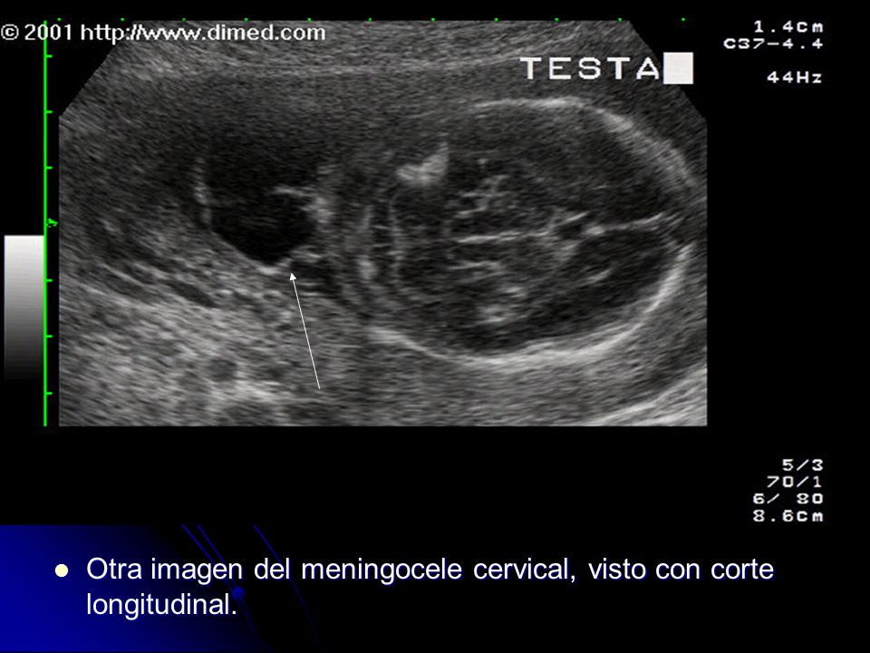 Otra imagen del meningocele cervical, visto con corte longitudinal.