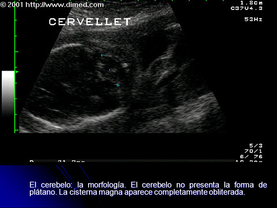 El cerebelo: la morfología. El cerebelo no presenta la forma de plátano.