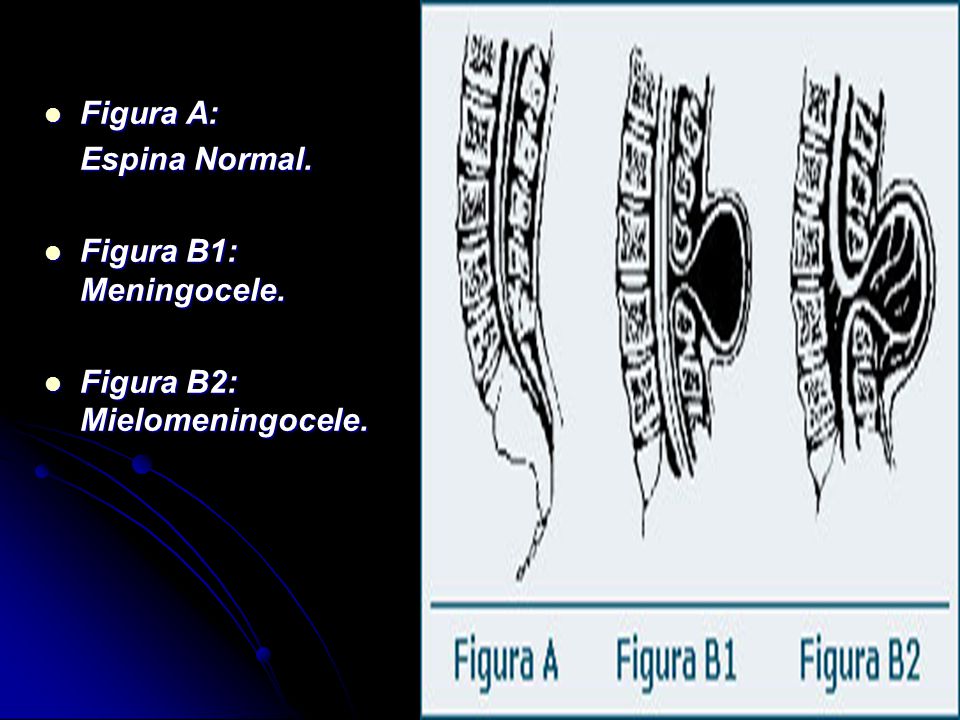 Figura A: Espina Normal. Figura B1: Meningocele. Figura B2: Mielomeningocele.