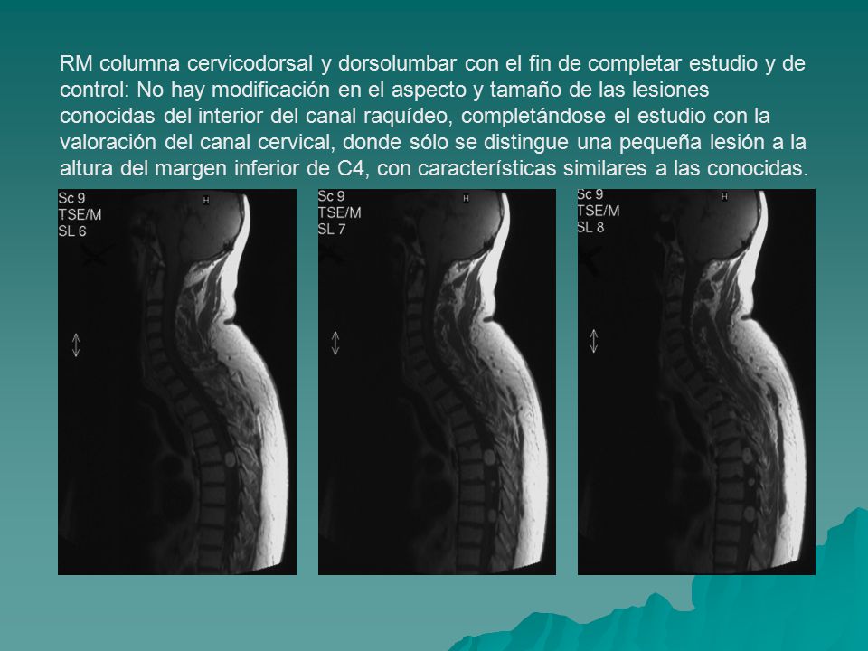 RM columna cervicodorsal y dorsolumbar con el fin de completar estudio y de control: No hay modificación en el aspecto y tamaño de las lesiones conocidas del interior del canal raquídeo, completándose el estudio con la valoración del canal cervical, donde sólo se distingue una pequeña lesión a la altura del margen inferior de C4, con características similares a las conocidas.