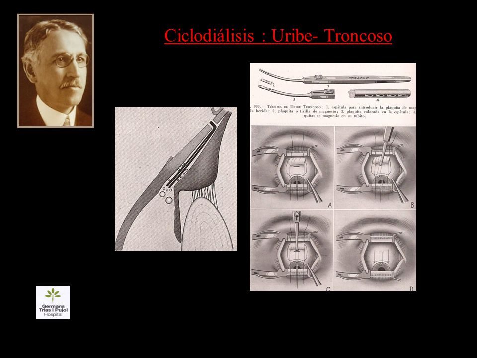 Ciclodiálisis : Uribe- Troncoso