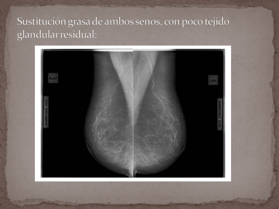Sustitución grasa de ambos senos, con poco tejido glandular residual: