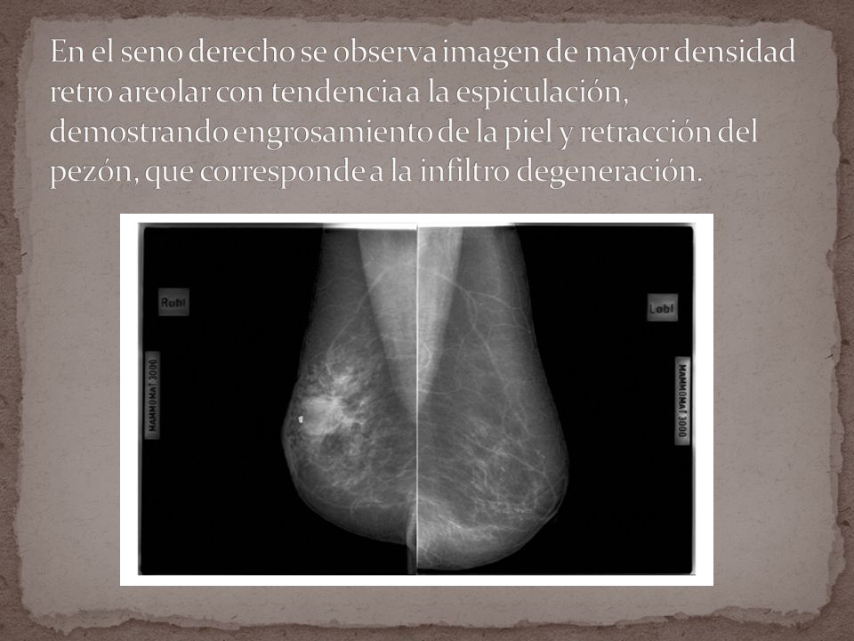 En el seno derecho se observa imagen de mayor densidad retro areolar con tendencia a la espiculación, demostrando engrosamiento de la piel y retracción del pezón, que corresponde a la infiltro degeneración.
