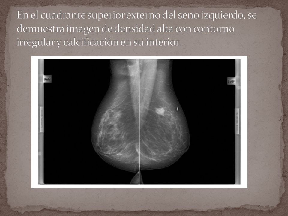 En el cuadrante superior externo del seno izquierdo, se demuestra imagen de densidad alta con contorno irregular y calcificación en su interior.