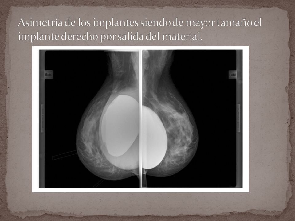 Asimetría de los implantes siendo de mayor tamaño el implante derecho por salida del material.