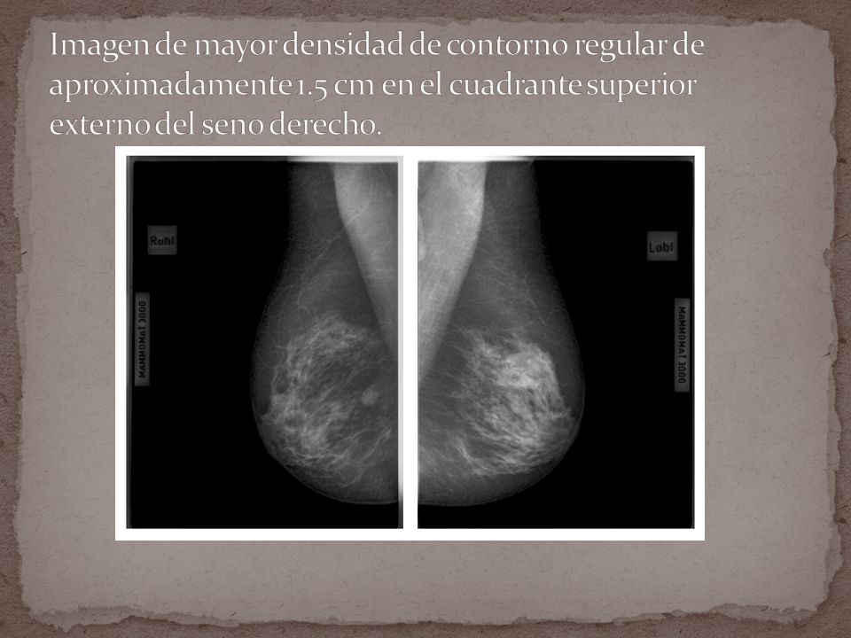 Imagen de mayor densidad de contorno regular de aproximadamente 1