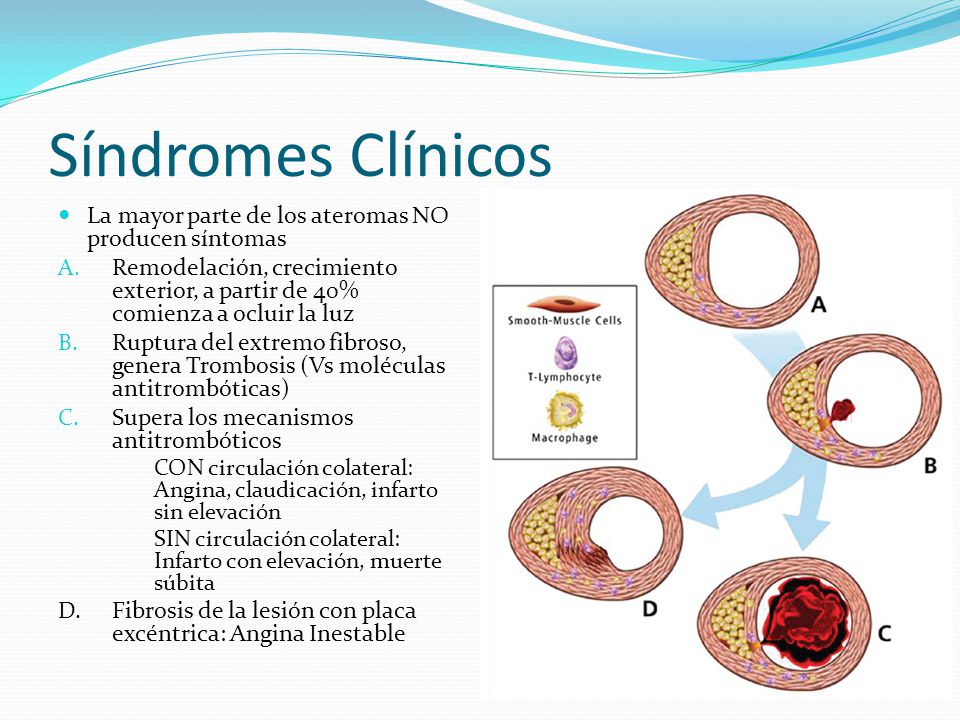 Síndromes Clínicos La mayor parte de los ateromas NO producen síntomas