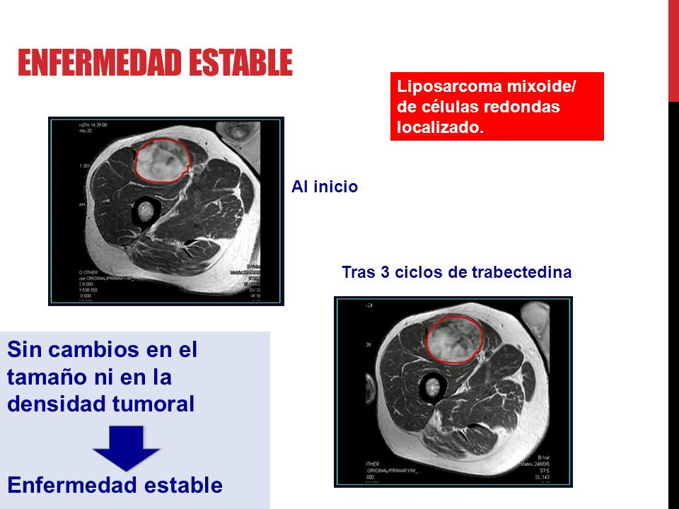 Enfermedad estable Sin cambios en el tamaño ni en la densidad tumoral