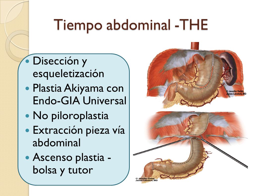 Tiempo abdominal -THE Disección y esqueletización